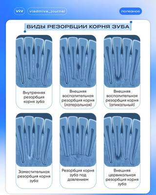 Диагностика резорбции корня перед эндодонтическим лечением.